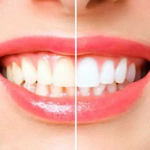 Teeth Whitening service
