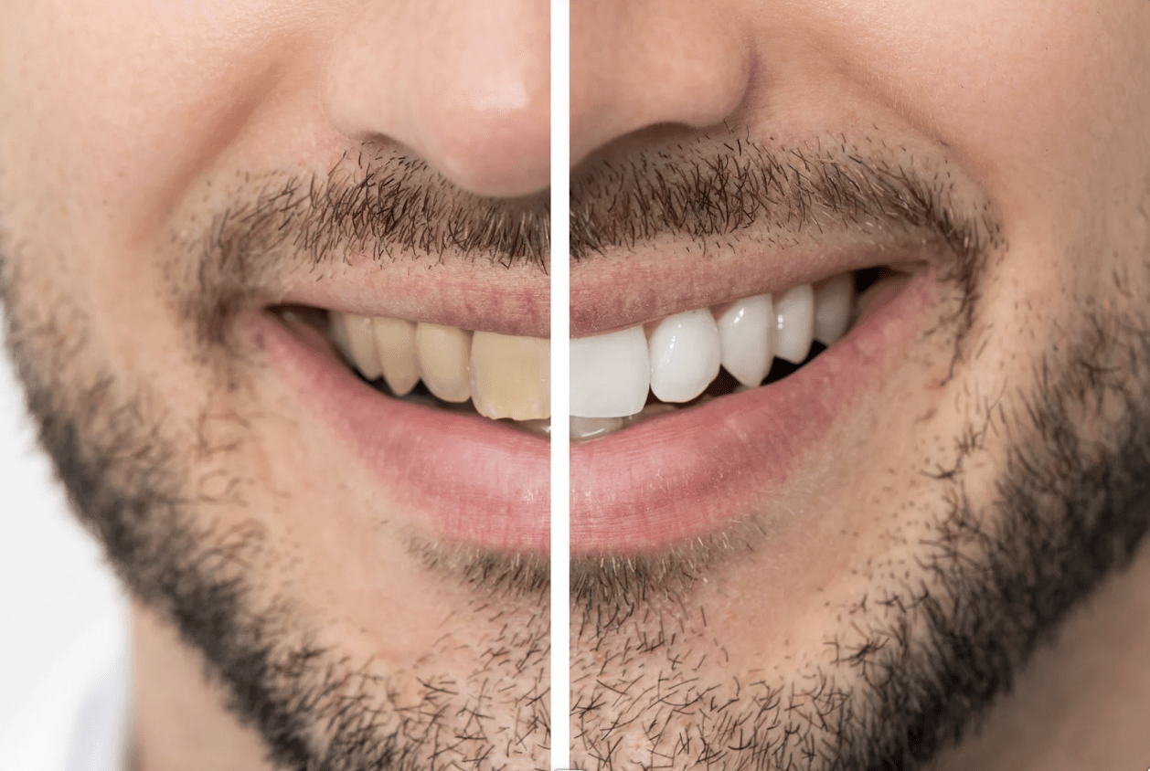 #TeethWhiteningPhoenix #PorcelainTeethWhitening #PhoenixSalon #SmileMakeoverAZ #AdvancedTeethWhitening #HydrogenPeroxideWhitening #PhoenixBeautySalon #TeethWhiteningNearMe #BrightSmilePhoenix #BeautySalonPhoenix #CosmeticTeethWhitening #SalonServicesPhoenix #TeethWhiteningAZ #LashesAndBodyOnFleek #GlowUpPhoenix #SmileBrightAZ #AffordableTeethWhitening #BestSalonPhoenix #BrighterSmile #SensitiveTeethSafe #WhiterTeethFast #BeautyInPhoenix #EventReadySmile #LocalSalonPhoenix #BodyAndLashPhoenix #SalonGlowUp #SelfCarePhoenix #ToothWhiteningSalon #NonInvasiveWhitening #PhoenixBeautyExpert