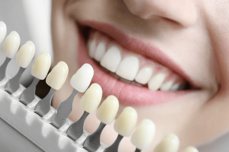 Teeth Whitening