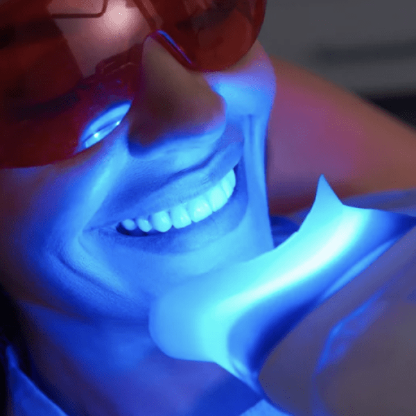 Porcelain Teeth Whitening AZ