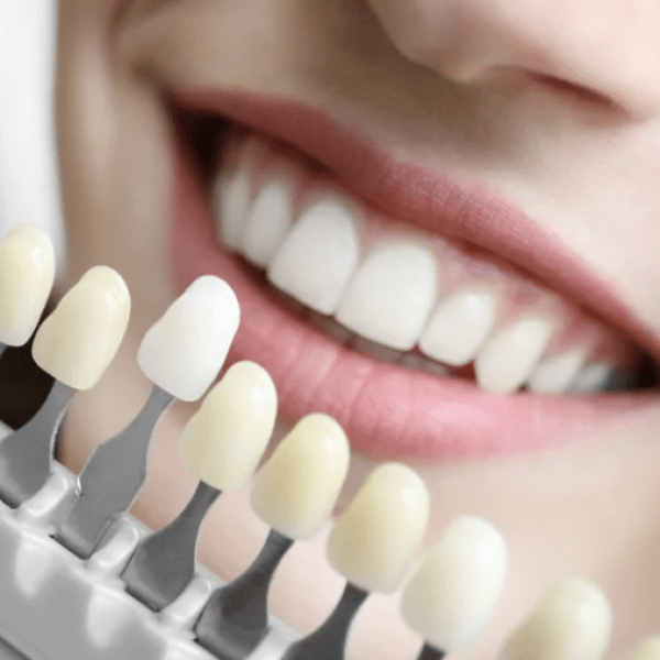 Teeth Whitening